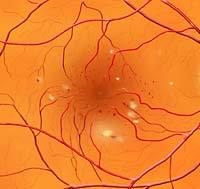 Background Diabetic Retinopathy