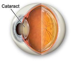 Cataract