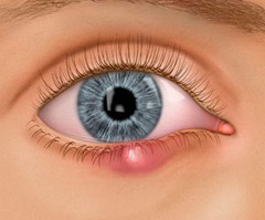 Chalazion