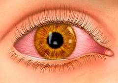 Conjunctivitis