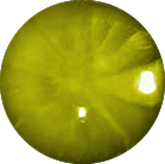 Cortical Cataracts