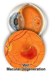 Macular Degeneration