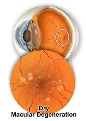 Macular Degeneration