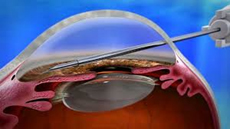 Minimally Invasive Glaucoma Surgery