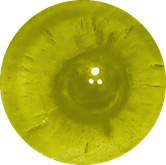 Posterior Subcapsular Cataracts