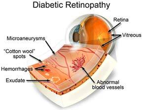 Proliferative Diabetic Retinopathy