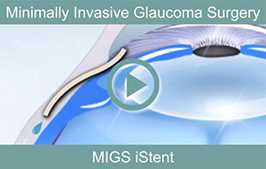 minimally-invasive-glaucoma-surgery-th