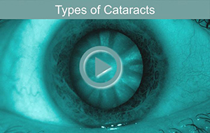 types-of-cataracts-th